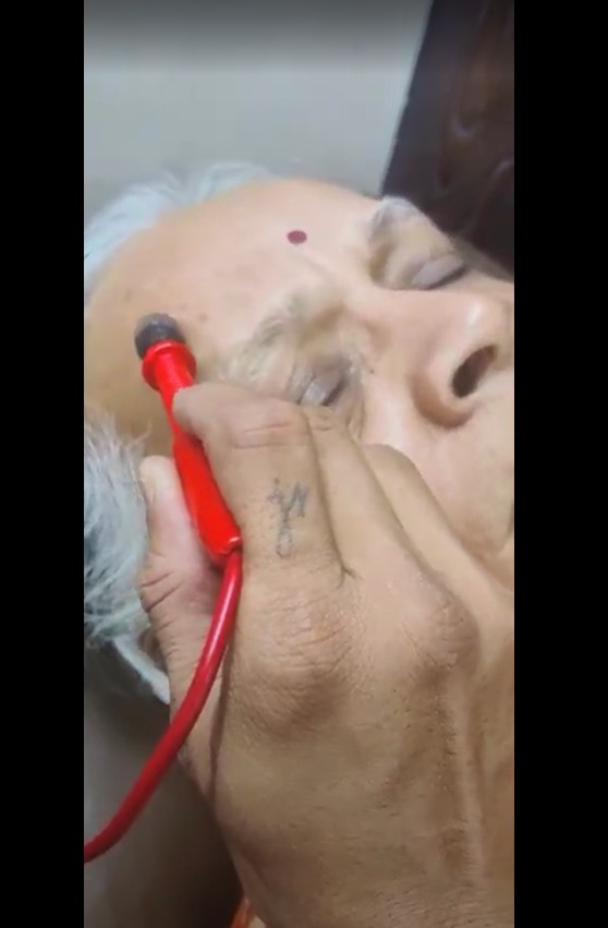 Treating Trigeminal Neuralgia